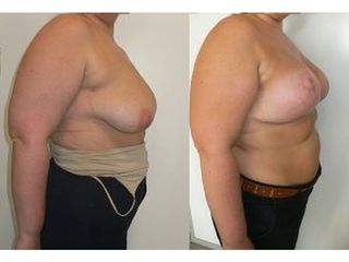 Antes y después Mastopexia