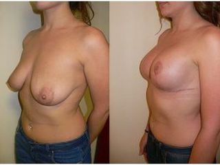 Antes y después Mastopexia