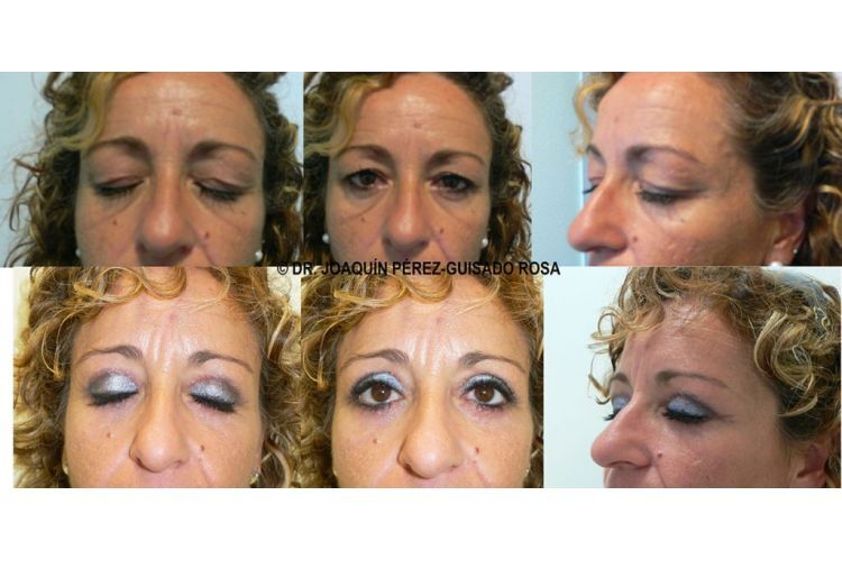 Eliminación ojeras antes y después - 738088