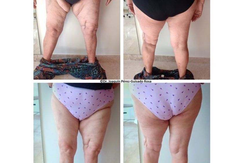 Lipedema antes y después - 738090