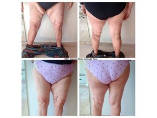 Antes y después Liposucción - Dr. Joaquín Pérez Guisado Rosa