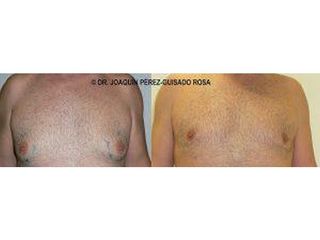 Antes y después Ginecomastia - Dr. Joaquín Pérez Guisado Rosa