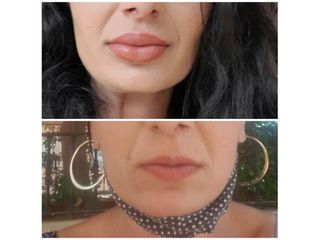 Antes y después Aumento de labios - Dr. Joaquín Pérez Guisado Rosa