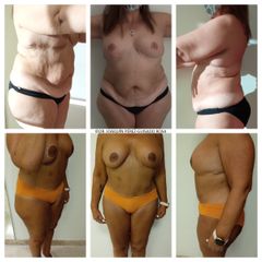 Dr. Joaquín Pérez Guisado Rosa - abdominoplastia y perdida de peso