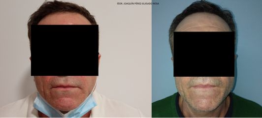 Dr. Joaquín Pérez Guisado Rosa - lips lift cambio sutil