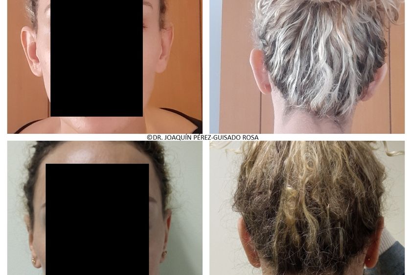 Otoplastia antes y después - 837161