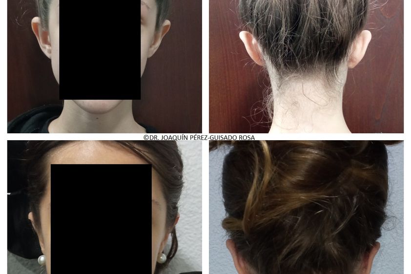 Otoplastia antes y después - 837167