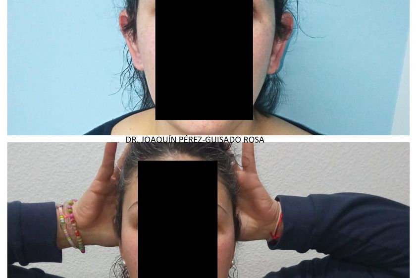 Otoplastia antes y después - 862241