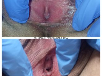 Labioplastia antes y después - 862245