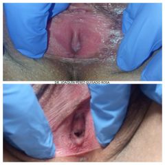 Labioplastia - Dr. Joaquín Pérez Guisado Rosa