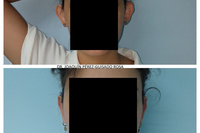Otoplastia antes y después - 862246
