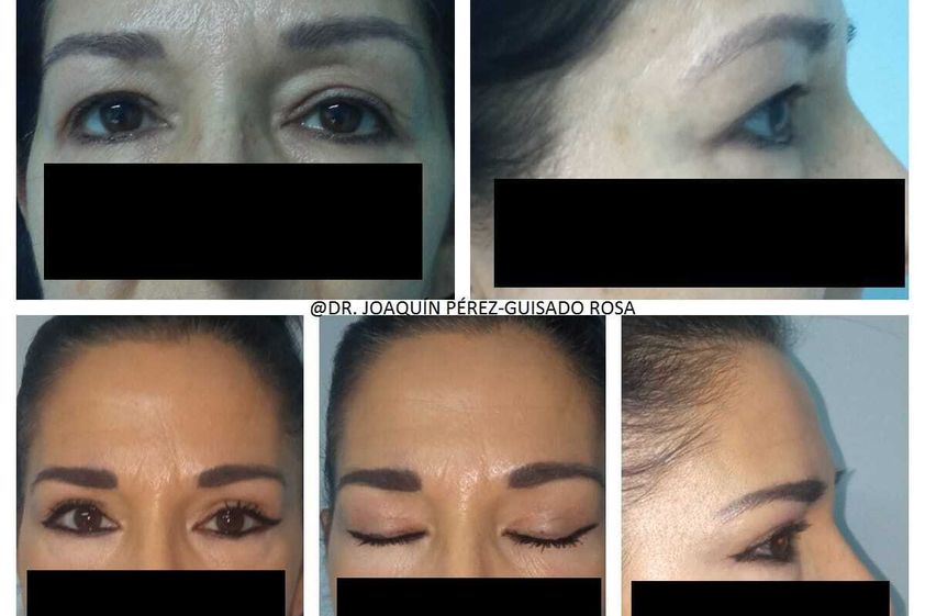 Blefaroplastia antes y después - 862251