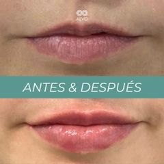 Aumento labios - Clínicas Aevo