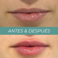 Aumento labios - Clínicas Aevo