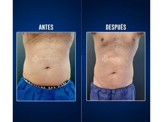Criolipólisis - Clínicas Aevo