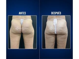 Criolipólisis - Clínicas Aevo