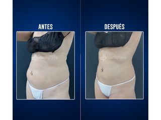 Criolipólisis - Clínicas Aevo