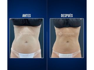 Criolipólisis - Clínicas Aevo