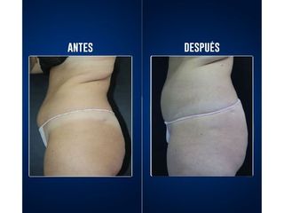 Criolipólisis - Clínicas Aevo