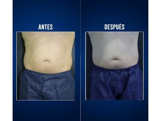 Criolipólisis - Clínicas Aevo
