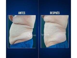Criolipólisis - Clínicas Aevo