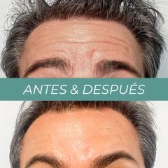Eliminación de arrugas - Clínicas Aevo