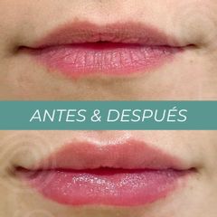 Aumento labios - Clínicas Aevo