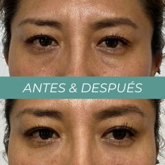 Eliminación ojeras - Clínicas Aevo