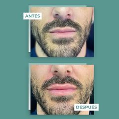 Aumento labios - Clínicas Aevo