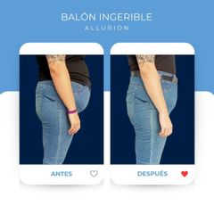 Balón Ingerible Allurion - Clínicas Aevo