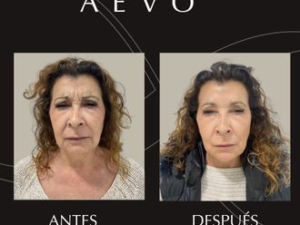 Rejuvenecimiento facial antes y después - 868613