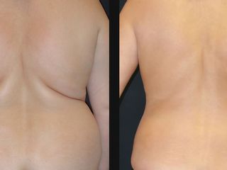 Antes y después lipoláser espalda