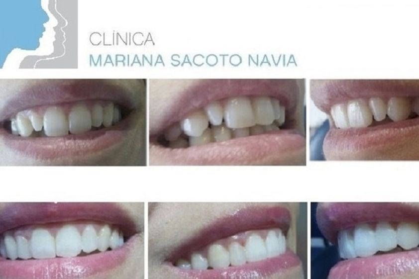 Carillas dentales antes y después - 516520