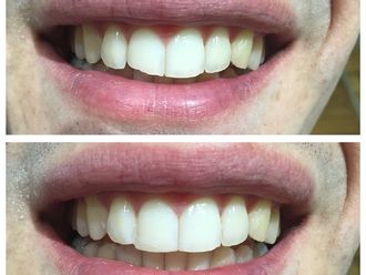 Carillas dentales - 516521