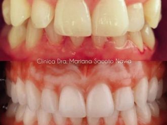 Blanqueamiento dental - 786022