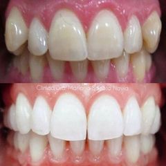 Blanqueamiento dental - Clínica Dra. Mariana Sacoto Navia