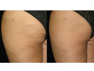 Mesoterapia