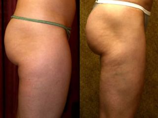 Lipoescultura
