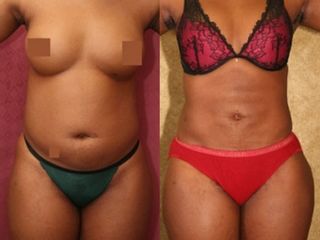 Lipoescultura