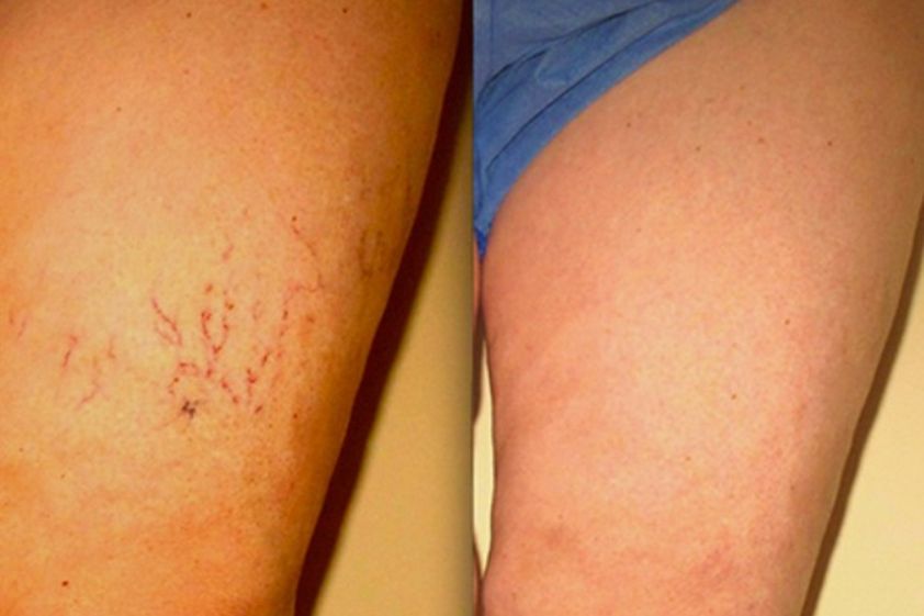 Tratamiento varices antes y después - 498351