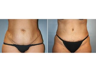 Abdominoplastia