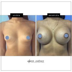 Aumento de pecho - Clínica Dr. Jiménez