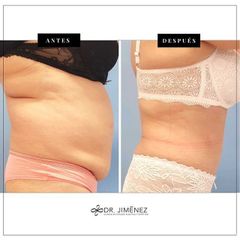 Abdominoplastia - Clínica Dr. Jiménez