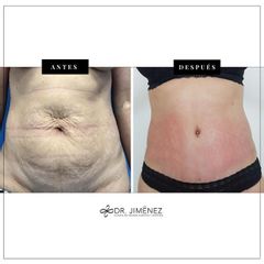 Abdominoplastia - Clínica Dr. Jiménez