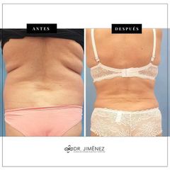Abdominoplastia - Clínica Dr. Jiménez