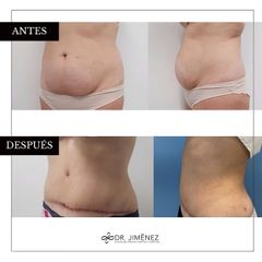 Abdominoplastia - Clínica Dr. Jiménez