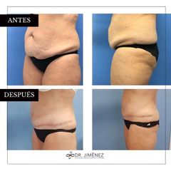 Abdominoplastia - Clínica Dr. Jiménez