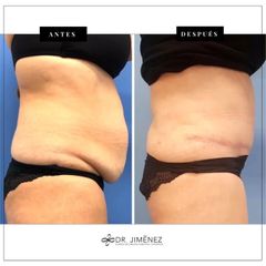 Abdominoplastia - Clínica Dr. Jiménez