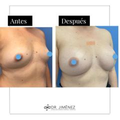 Aumento de pecho - Clínica Dr. Jiménez