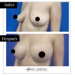 Aumento de pecho - Clínica Dr. Jiménez